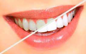 sbiancamento dentale